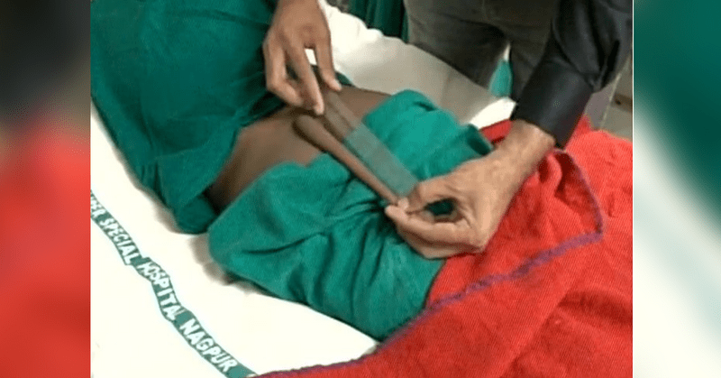 Neurosurgeons -remove -18 cm-long -'tail'- from -Nagpur- boy's- back