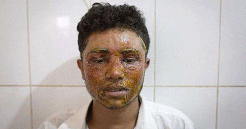 acid attack victim