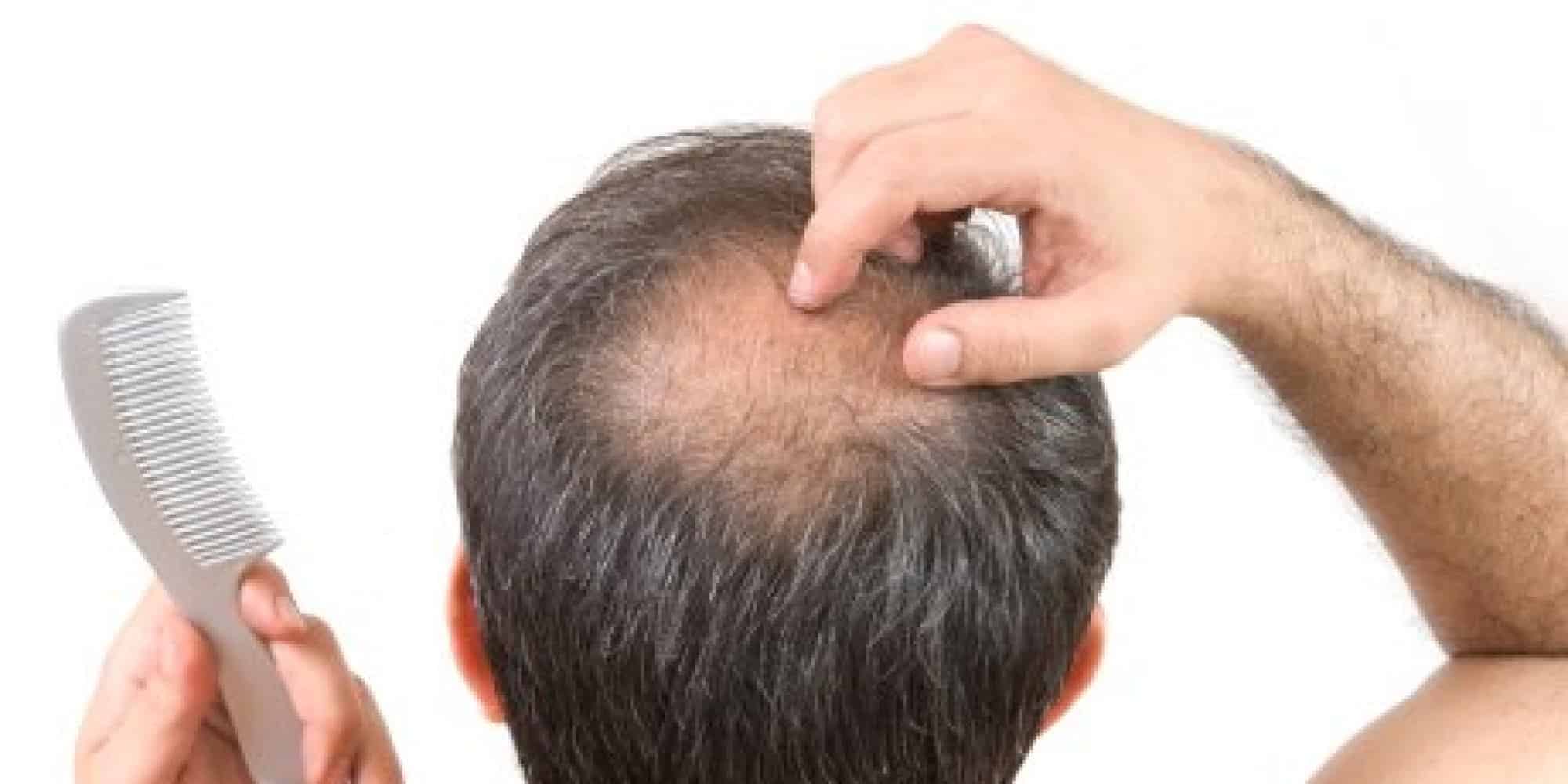 HAIR LOSS