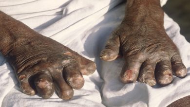 Leprosy_deformities_hands