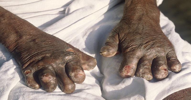 Leprosy_deformities_hands